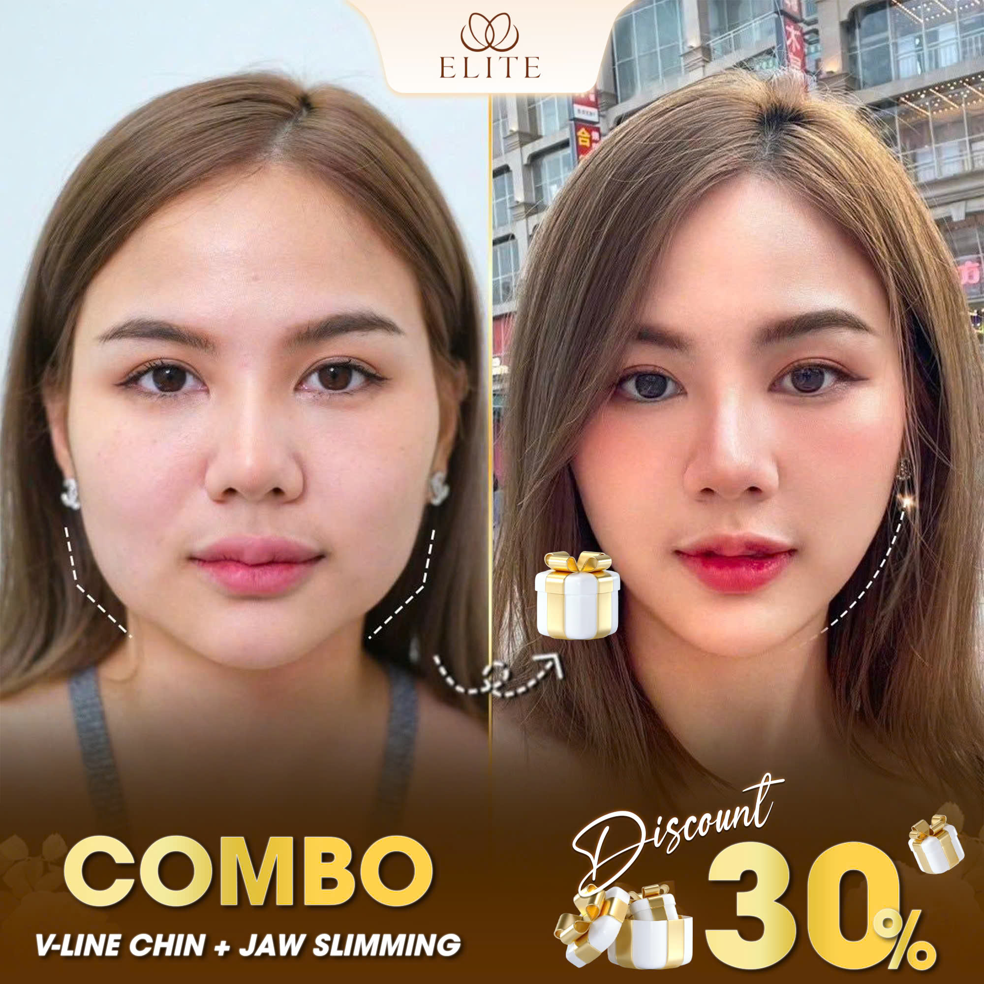 ELITE Beauty - No. 1 Dermatology salon in Laguna Facebook ad: Disscount Up To 30% First 20 customers only
