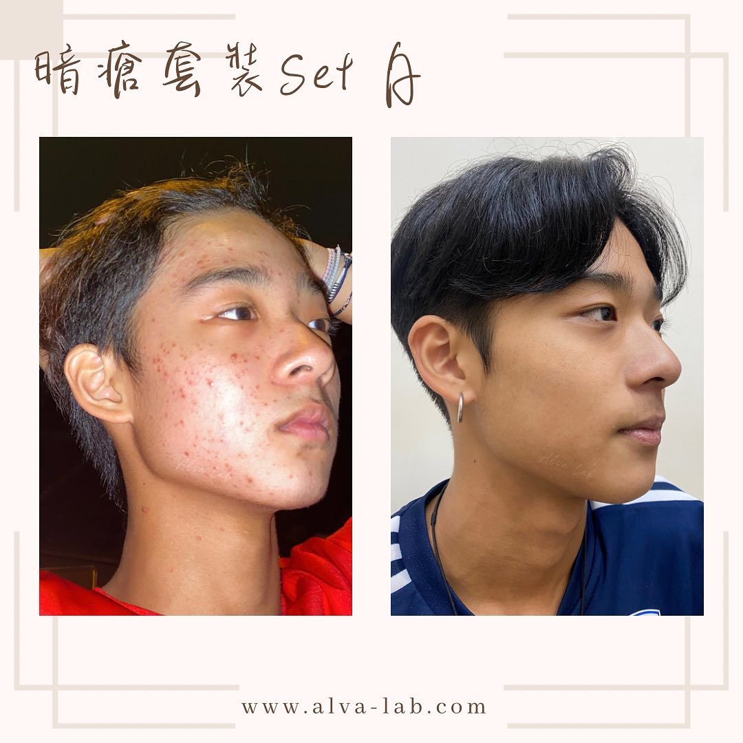 Alva Lab - natural skincare Facebook ad: Set A 真係幫到好多暗瘡皮膚