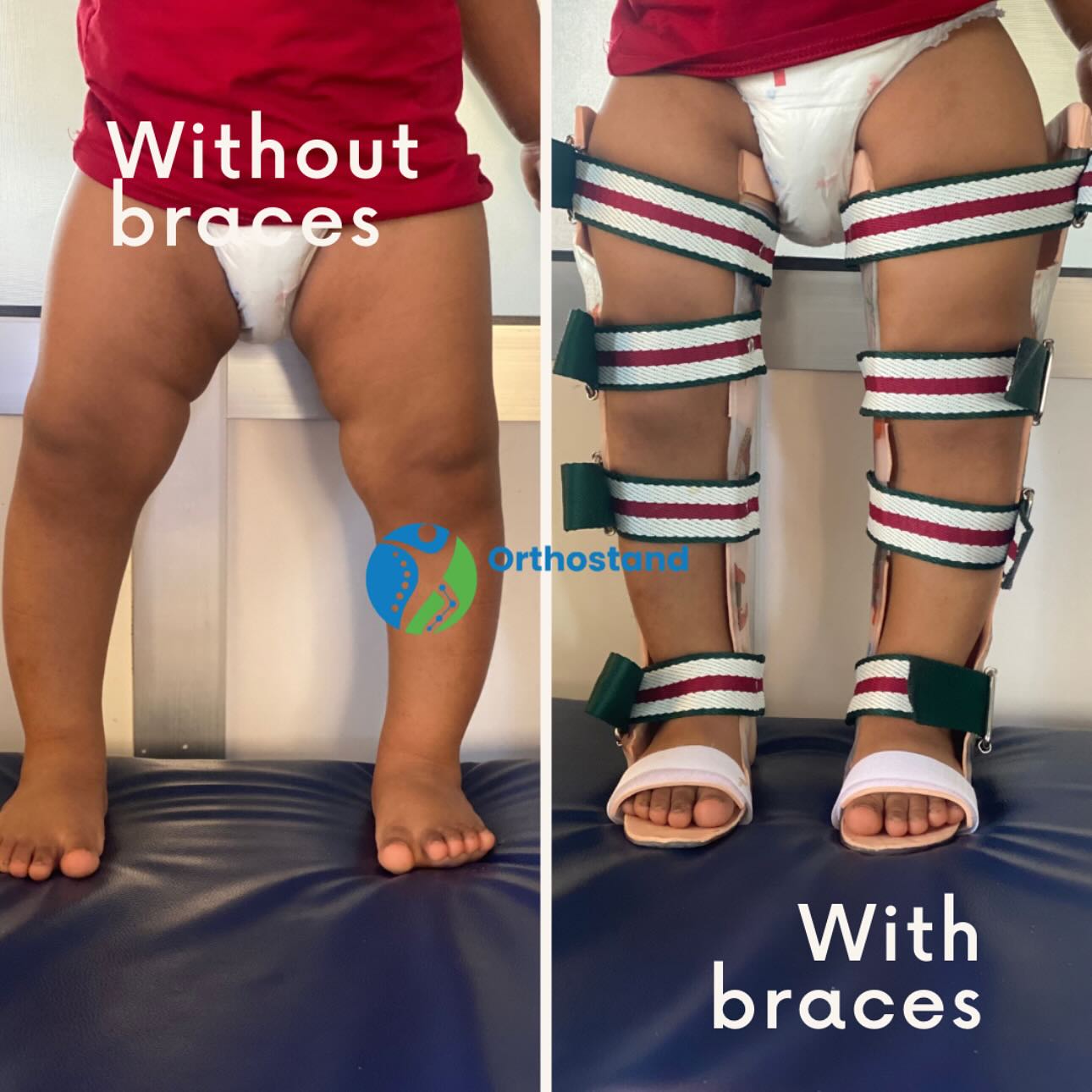 Orthostand mobility solution Facebook ad: BOW LEG MANAGEMENT WITH BRACES
