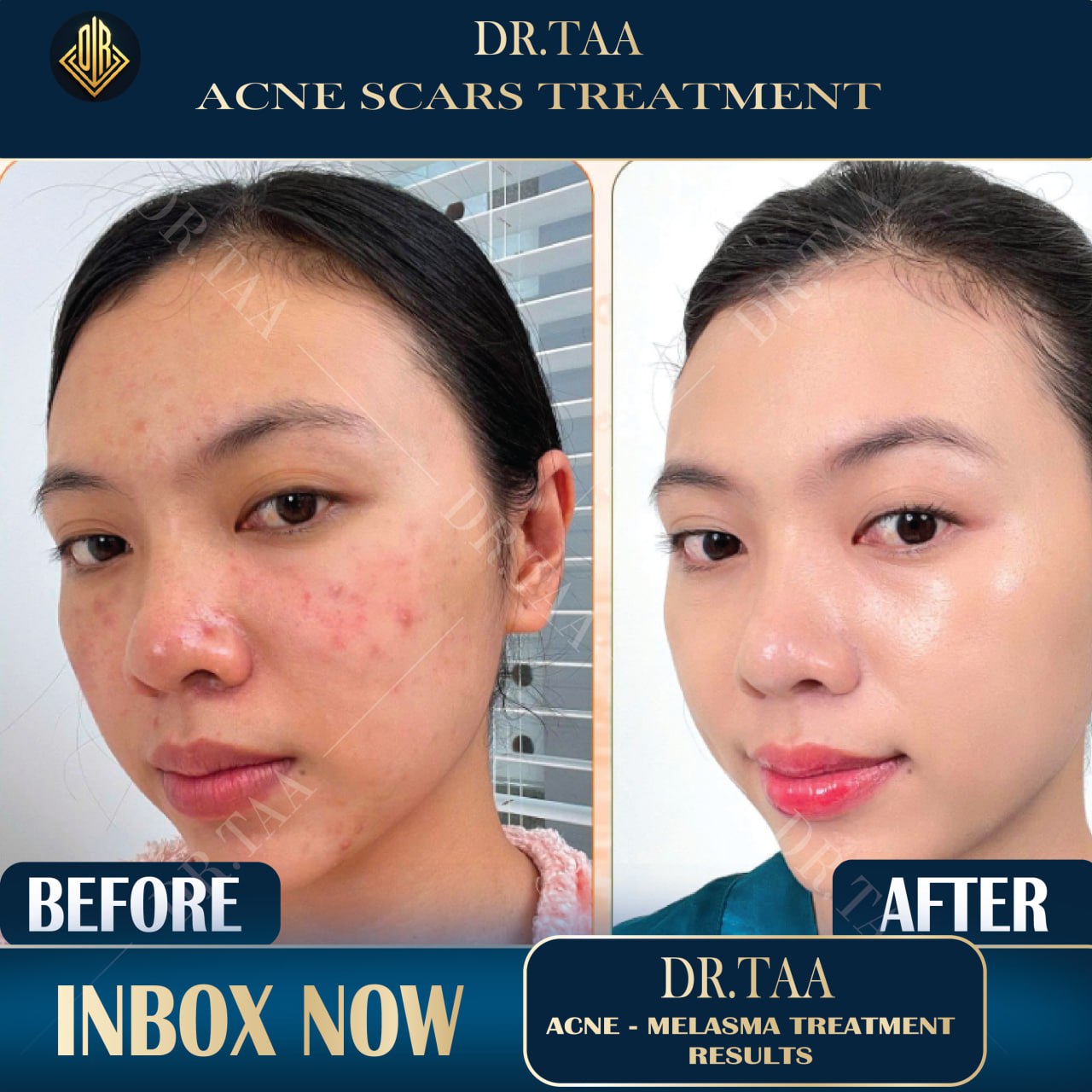 Dr.Taa Clinic - K Beauty center Poipet Facebook ad: ERASE DARK SPOTS, SMOOTH SCARS