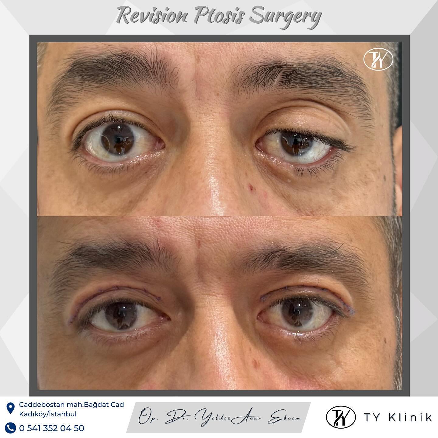 opdryildizacarebcim Facebook ad: Revision Ptosis Surgery 9th Day