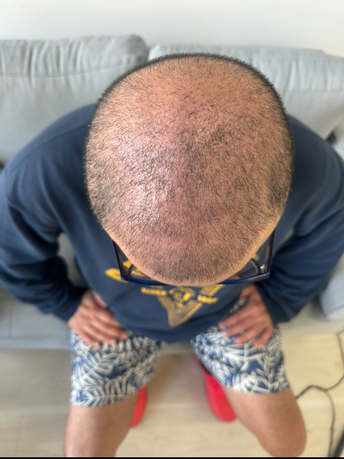 Scalp Ink Australia Facebook ad: Scalp Micropigmentation (SMP) isn’t just for bald heads…