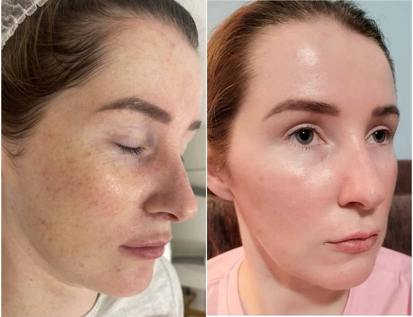 Pure skin + clinic Facebook ad: Erase Years in Minutes with Our BBL Hero Treatment, Book…