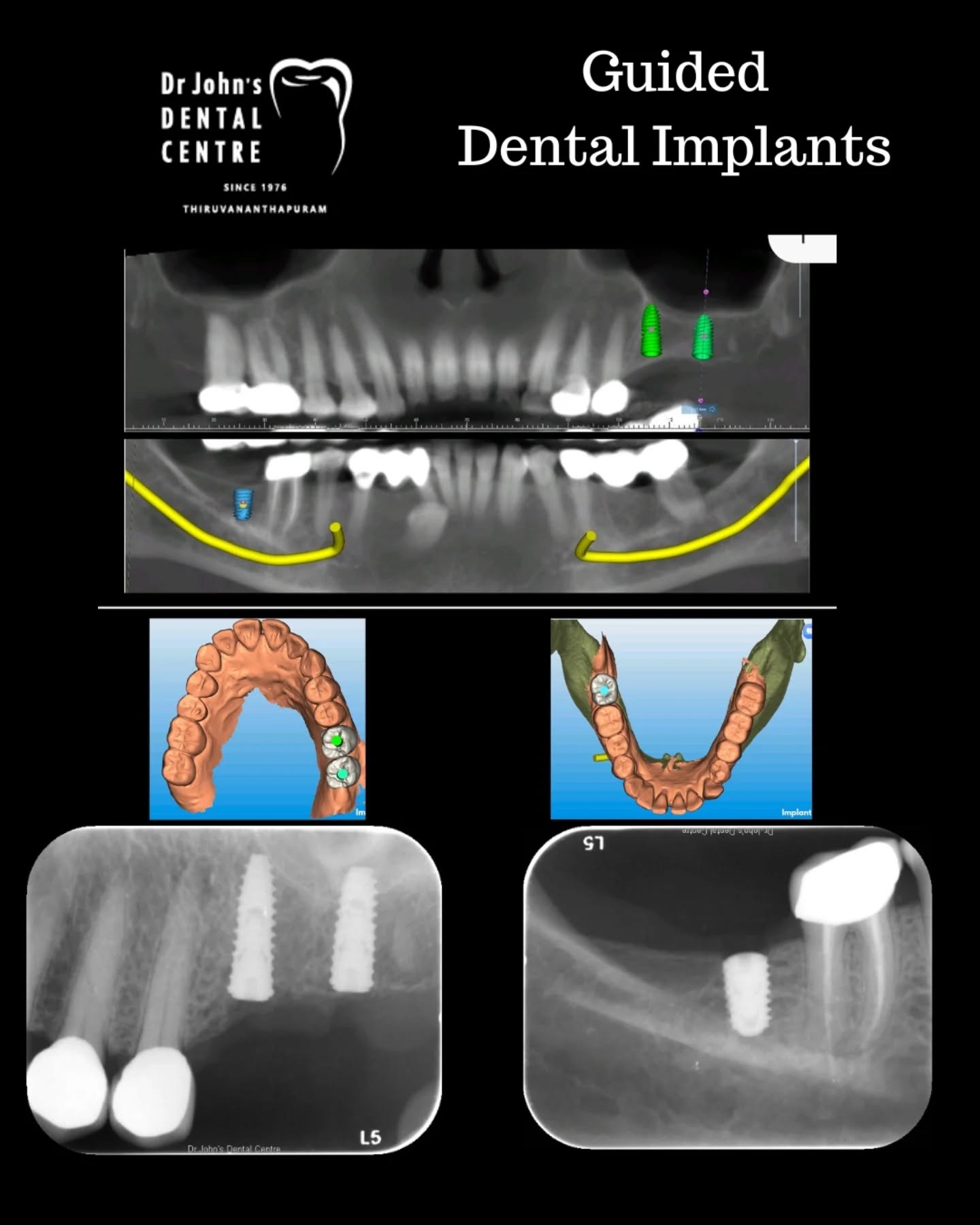 Drjohnsdentalcentre Facebook ad: Dental Implants for a Strong, Natural Smile at…