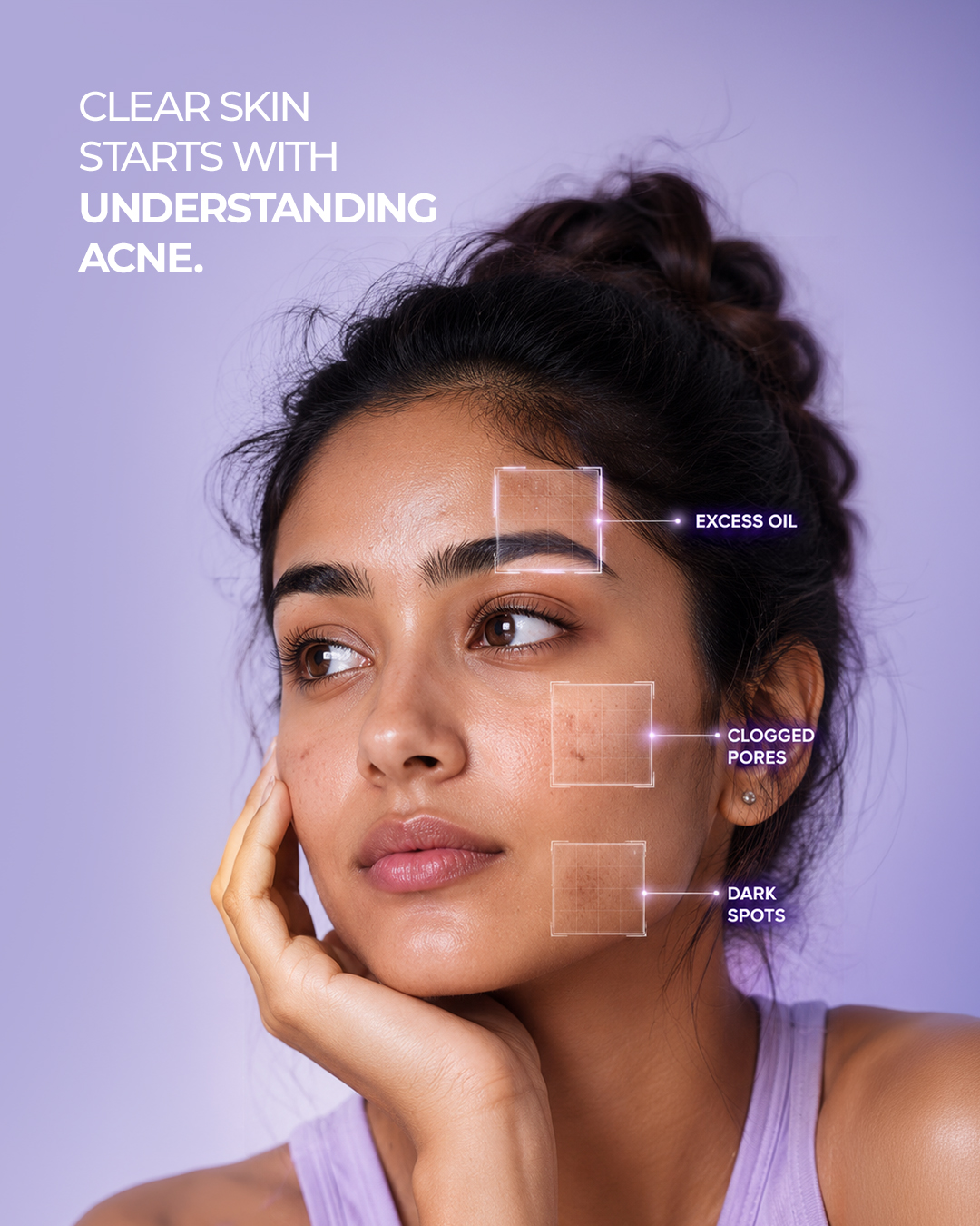 AcneStar Facebook ad: Acne-prone skin deals with more than just breakouts…