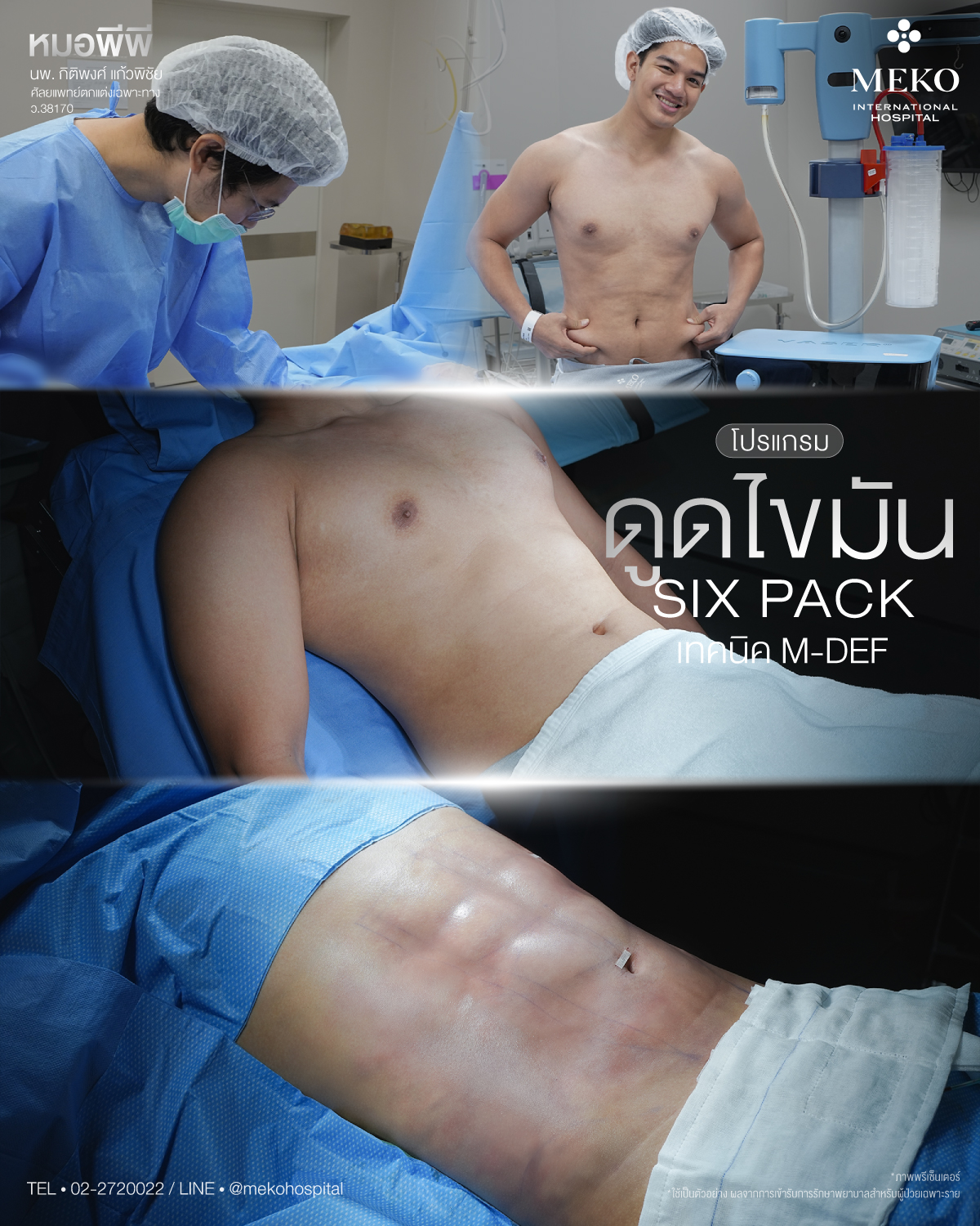 ดูดไขมัน ตัดหนังหน้าท้อง by Meko Hospital Facebook ad