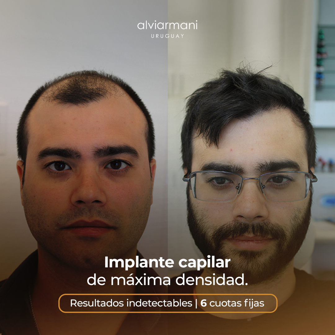 Alvi Armani Uruguay Facebook ad: Recuperá tu pelo hoy