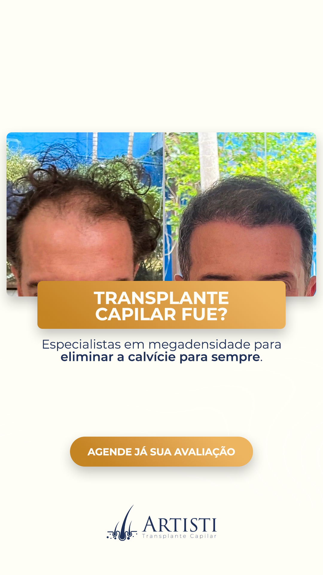 Artisti Transplante Capilar Facebook ad: Vença a Calvície