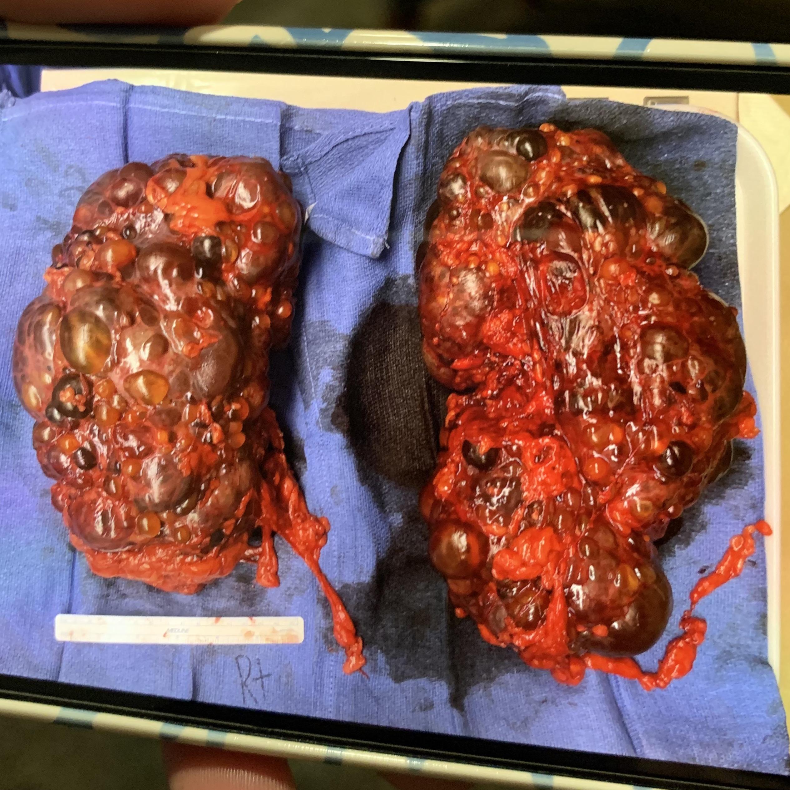 Lymphologist - Allison James, PhD Facebook ad