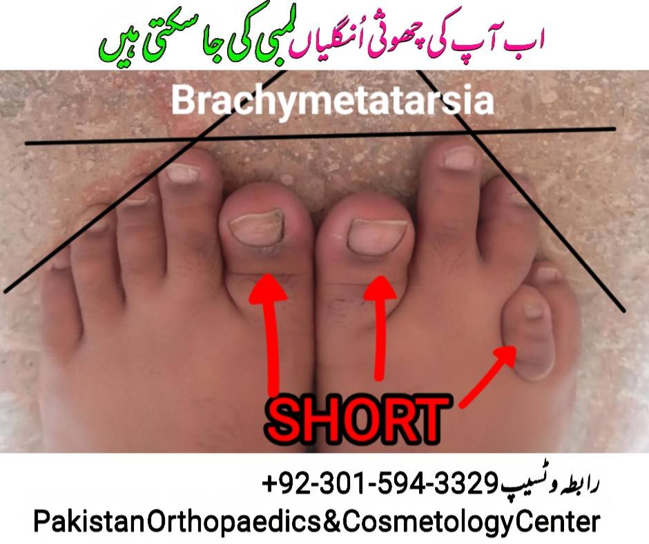 Pakistan Orthopaedic and Cosmetology Centre Facebook ad: اگر آپ کو انگلیوں (پاؤں کی) کی لمبائی…