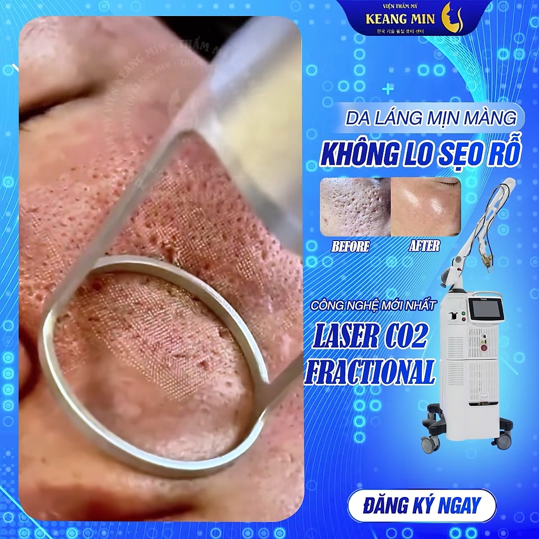Khoa Da Liễu Thẩm Mỹ Keang Min - 강민 미용실 Facebook ad: KỸ THUẬT TRỊ SẸO RỖ LASER CO2 FRACTIONAL Lấp đầy sẹo rỗ 90…