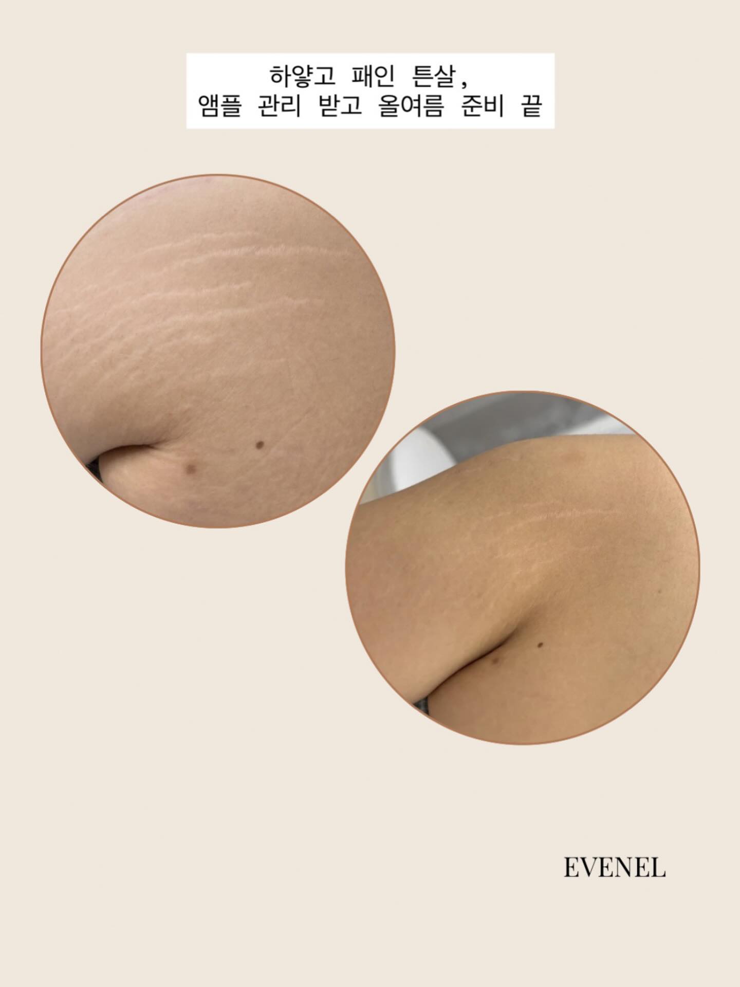Scar/Stretch marks cover/Skin regeneration Facebook ad: 하얗게 패인 튼살