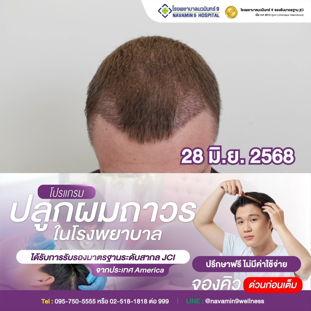 โรงพยาบาลนวมินทร์ 9 ปลูกผม เส้นผมและหนังศีรษะ Facebook ad: โรงพยาบาลนวมินทร์ 9