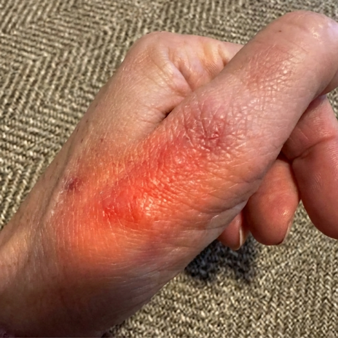 Dr. Thomas Abbott Facebook ad: Read This If You Have Bumps On Your Fingers