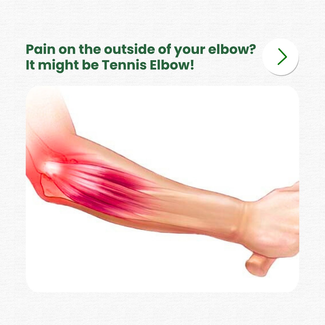 Orchard Health Clinic Facebook ad: Tennis Elbow is usually unrelated to Tennis but…