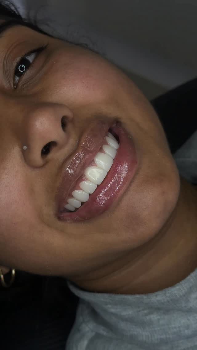 Sonrisa Perfecta Facebook ad: Diseño de sonrisa con carillas de resina estratificada