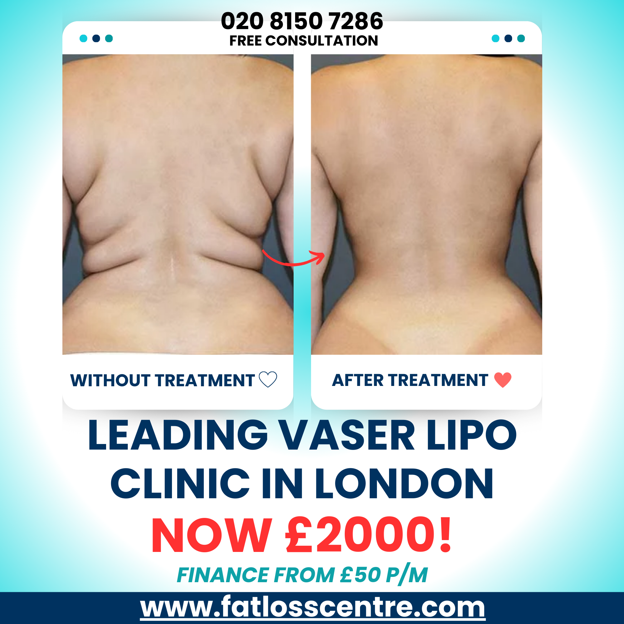 The Fat Loss Centre Facebook ad: Unbeatable Value - Vaser Lipo Now For £2000!