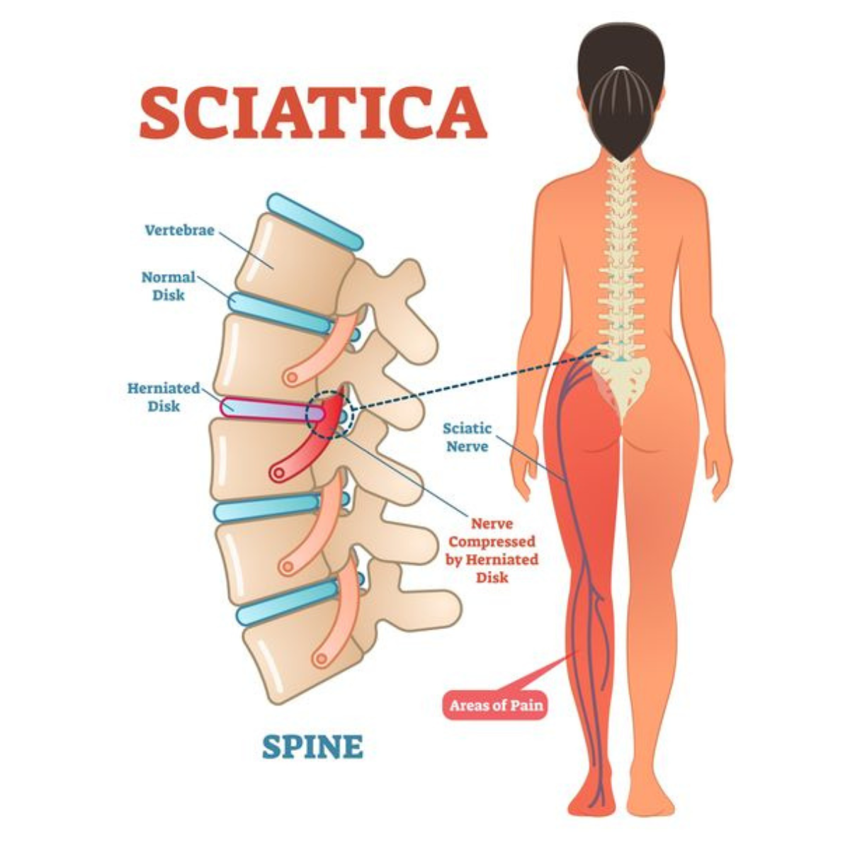 Today Disc, Bone & Joint Chiropractic Treatment Center Facebook ad: Non-Invasive & Drug-Free Sciatica Relief | Spinal…