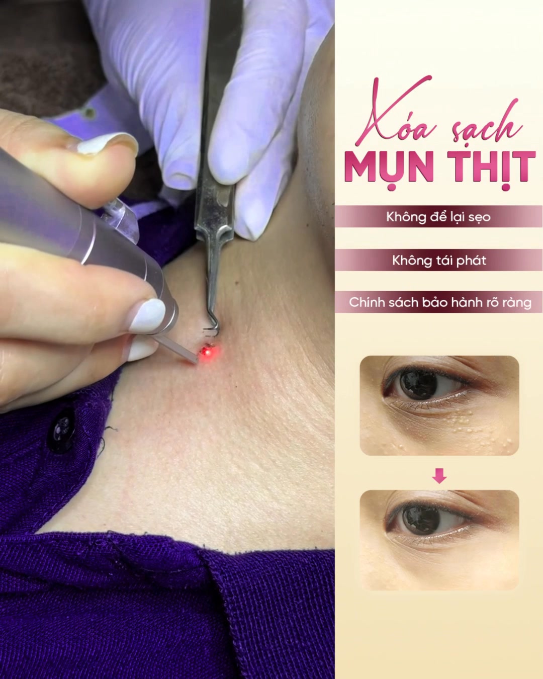 Lạc Trần - Trung tâm trị rạn da, sẹo lồi, lõm bằng laser Facebook ad: XÓA SẠCH DẤU TÍCH TRÊN DA