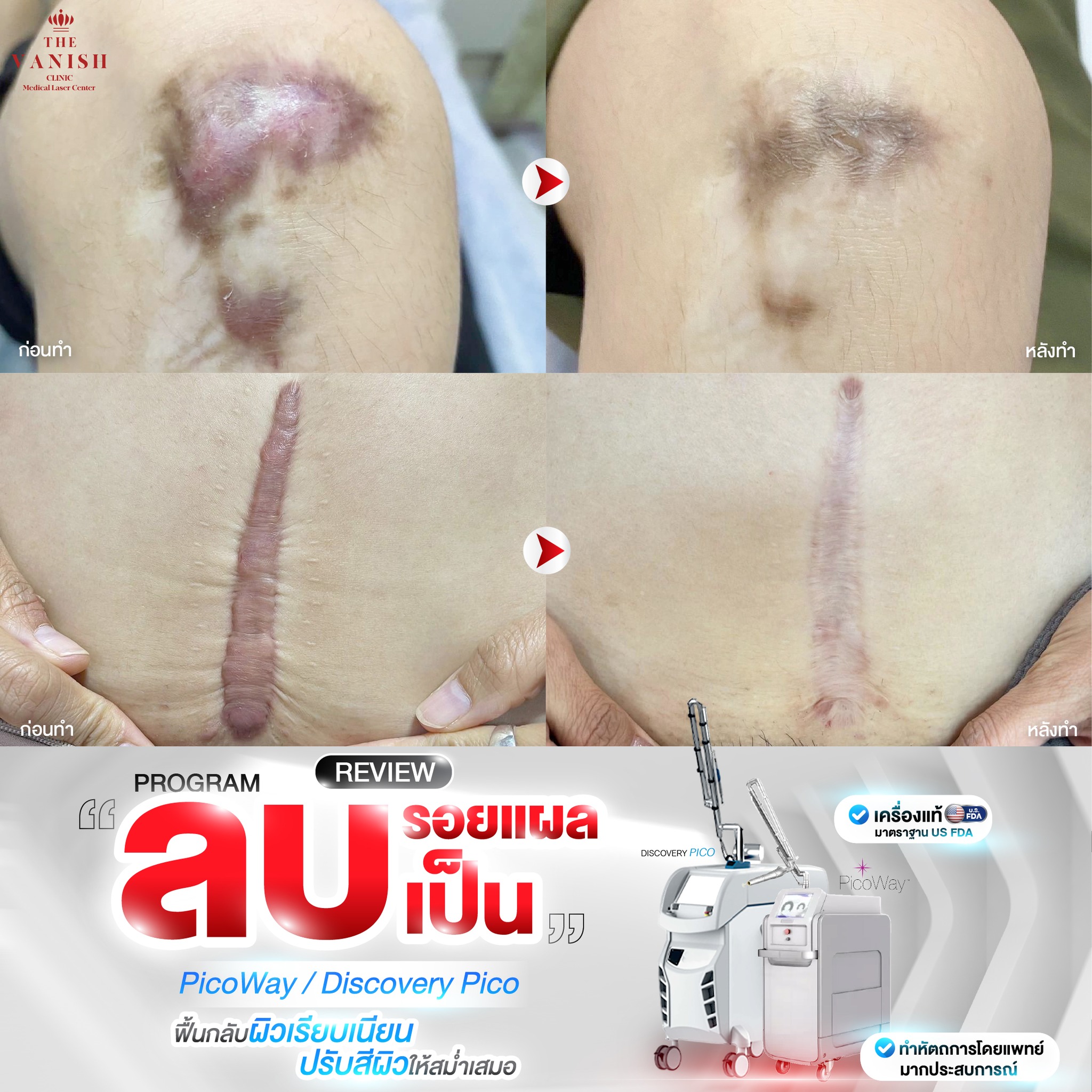 The Vanish Clinic โปรแกรมโบท็อก ฟิลเลอร์ Facebook ad