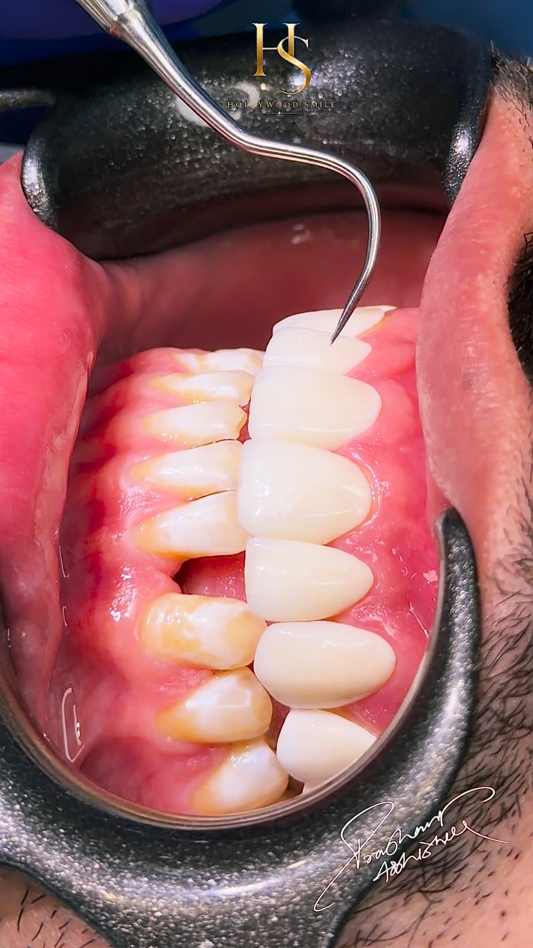 Hollywood Smile Chandigarh Facebook ad: Book Your Free Consultation >>>>