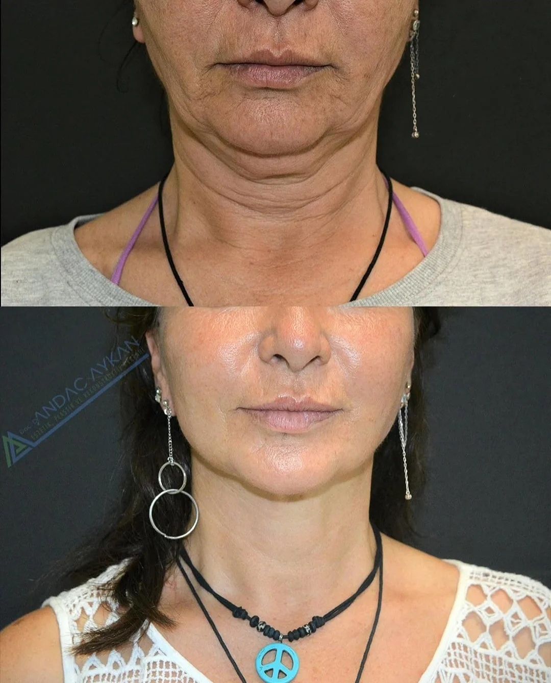 Together through Aging Facebook ad: Read this if you were told that facelift surgery was your…