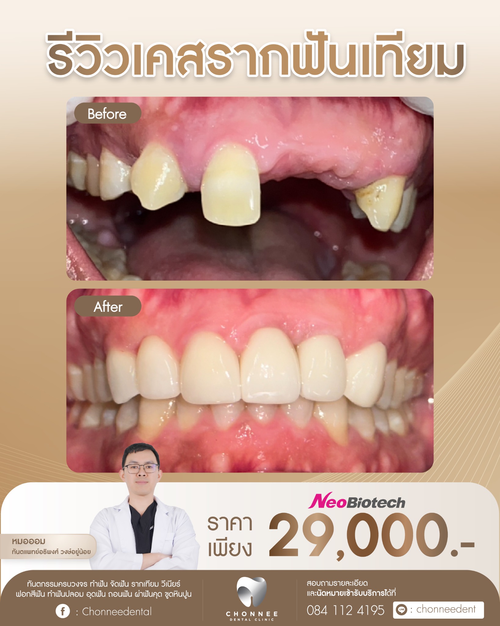 Chonnee Dental Clinic ทีมทันตแพทย์เฉพาะทางจัดฟัน รากฟันเทียม - ราชพฤกษ์ ตลิ่งชัน Facebook ad: รากฟันเทียม ราคาพิเศษ 29,000(รวมครอบฟัน) ปรึกษาฟรี!