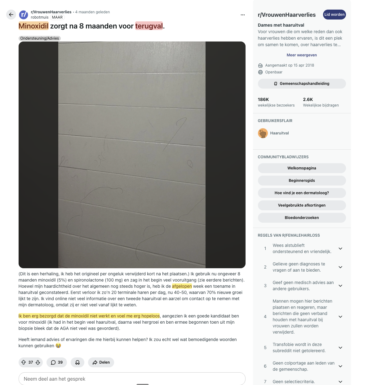Jeroen Gravestein Facebook ad: Extreme haaruitval na 14 maanden Minoxidil (en hoe ik dit…