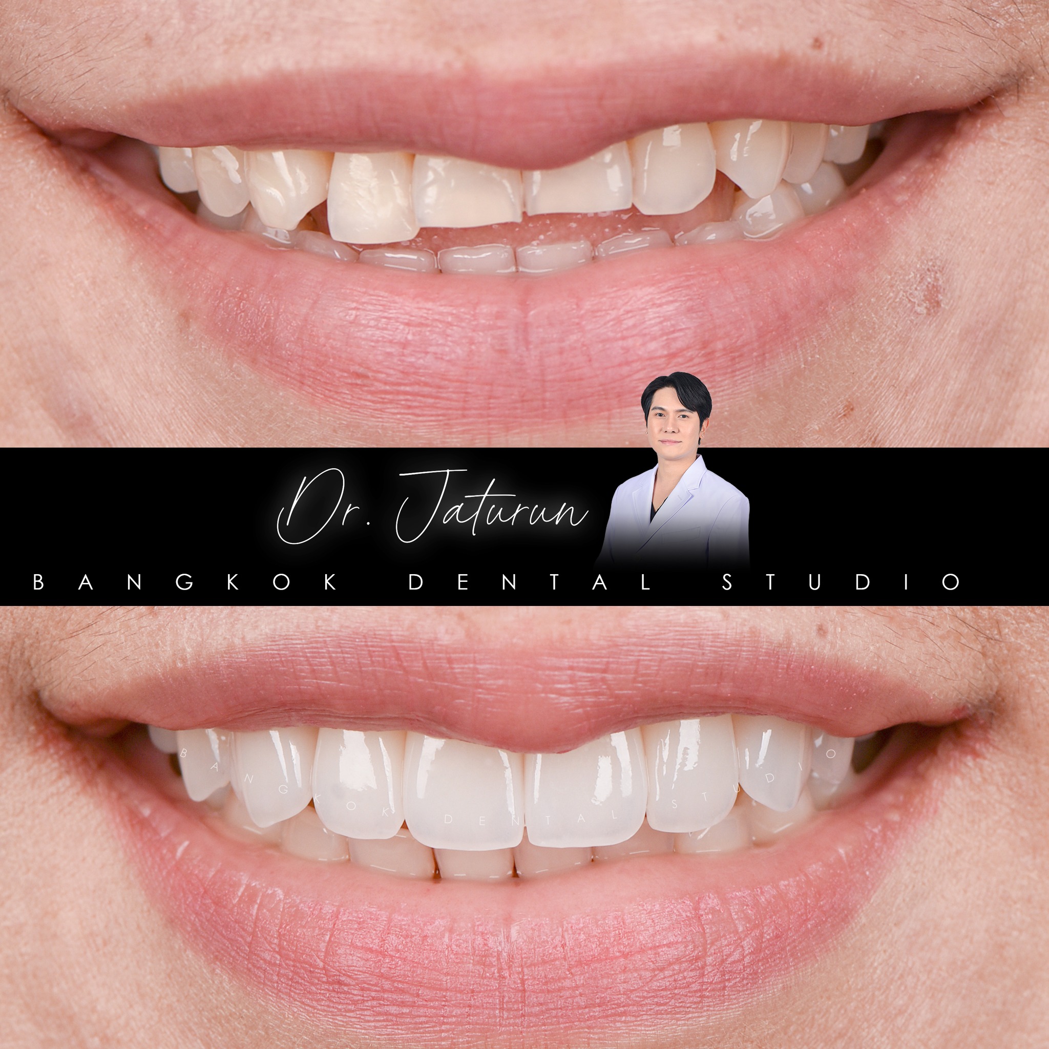 Bangkok Dental Studio-BDS บางกอก เด็นทัล สตูดิโอ ทำฟัน วีเนียร์ รากเทียม Facebook ad: Chat with us