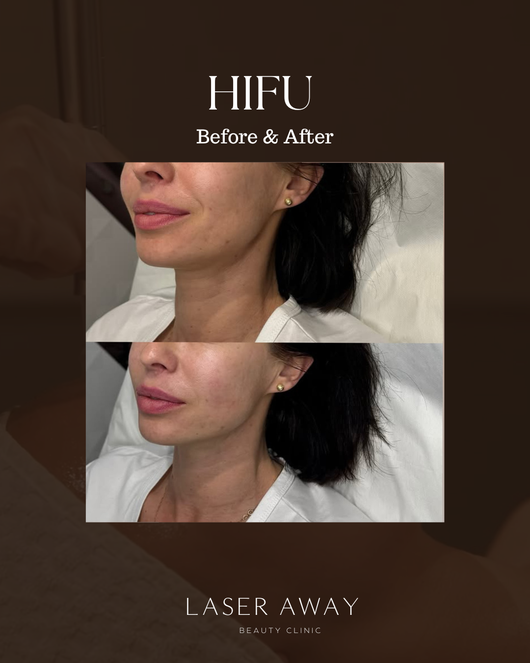 Laser-Away Beauty Clinics Facebook ad: HIFU behandeling bij Laser Away.