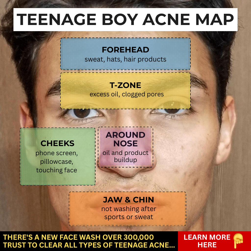Tyler Bennett Facebook ad: Read this if your son struggles with acne.
