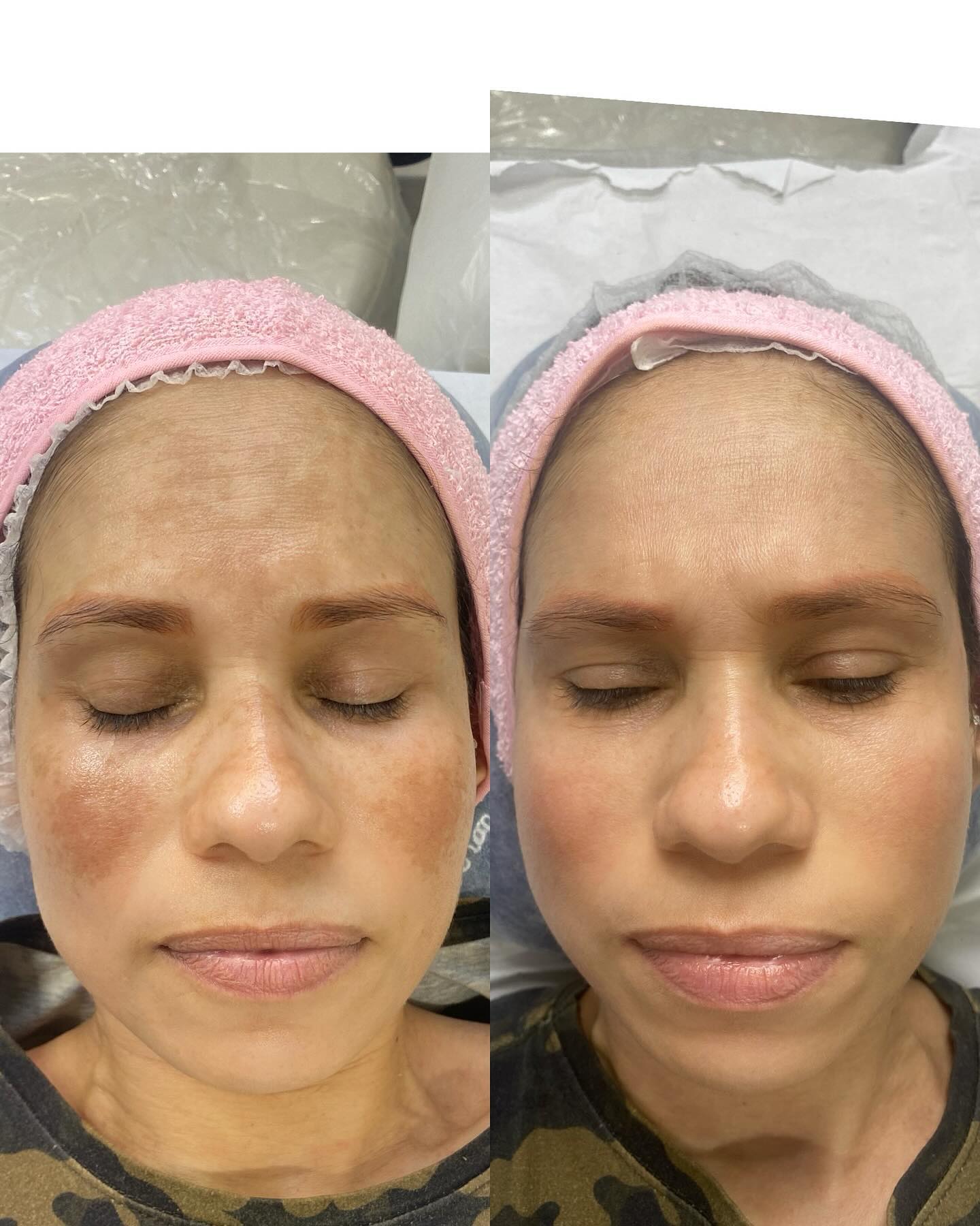 joana.angel2.estetica Facebook ad: Pessoal olha este resultado maravilhoso do tratamento para…