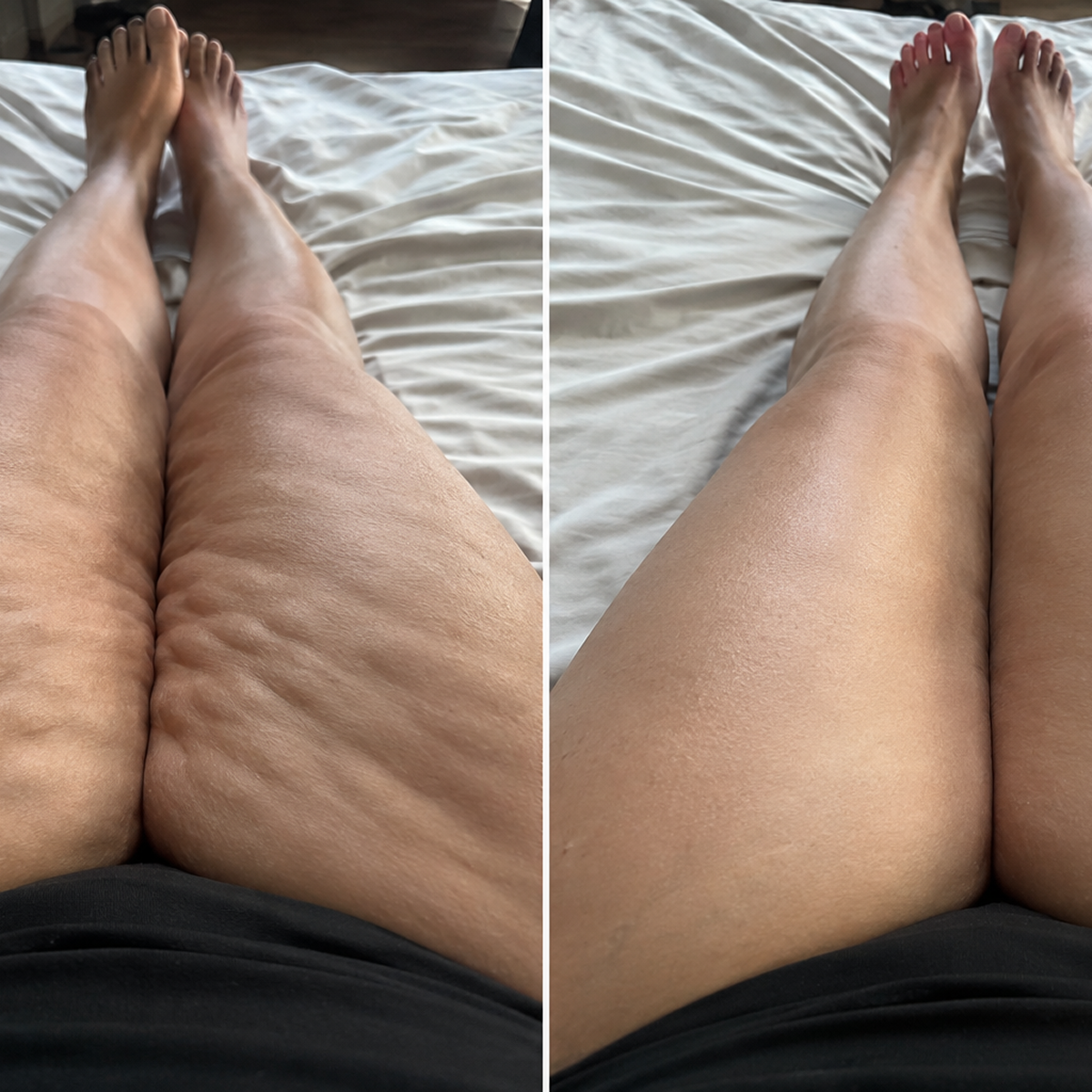 Emily Thompson Facebook ad: The Top 5 Cellulite Brands That Actually Release Trapped…