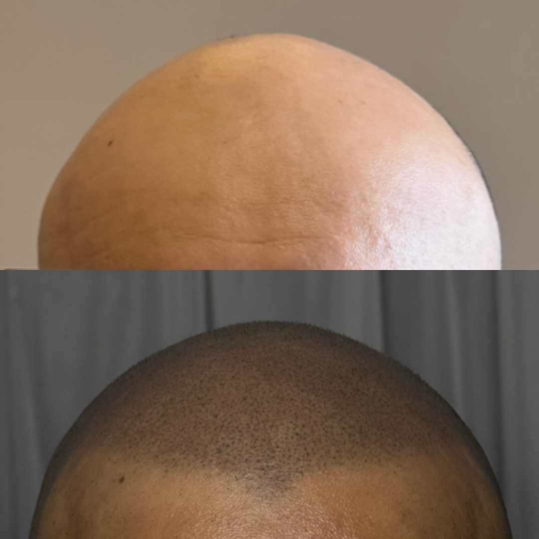 Micropigmentation Capillaire by. Idriss Soum Facebook ad