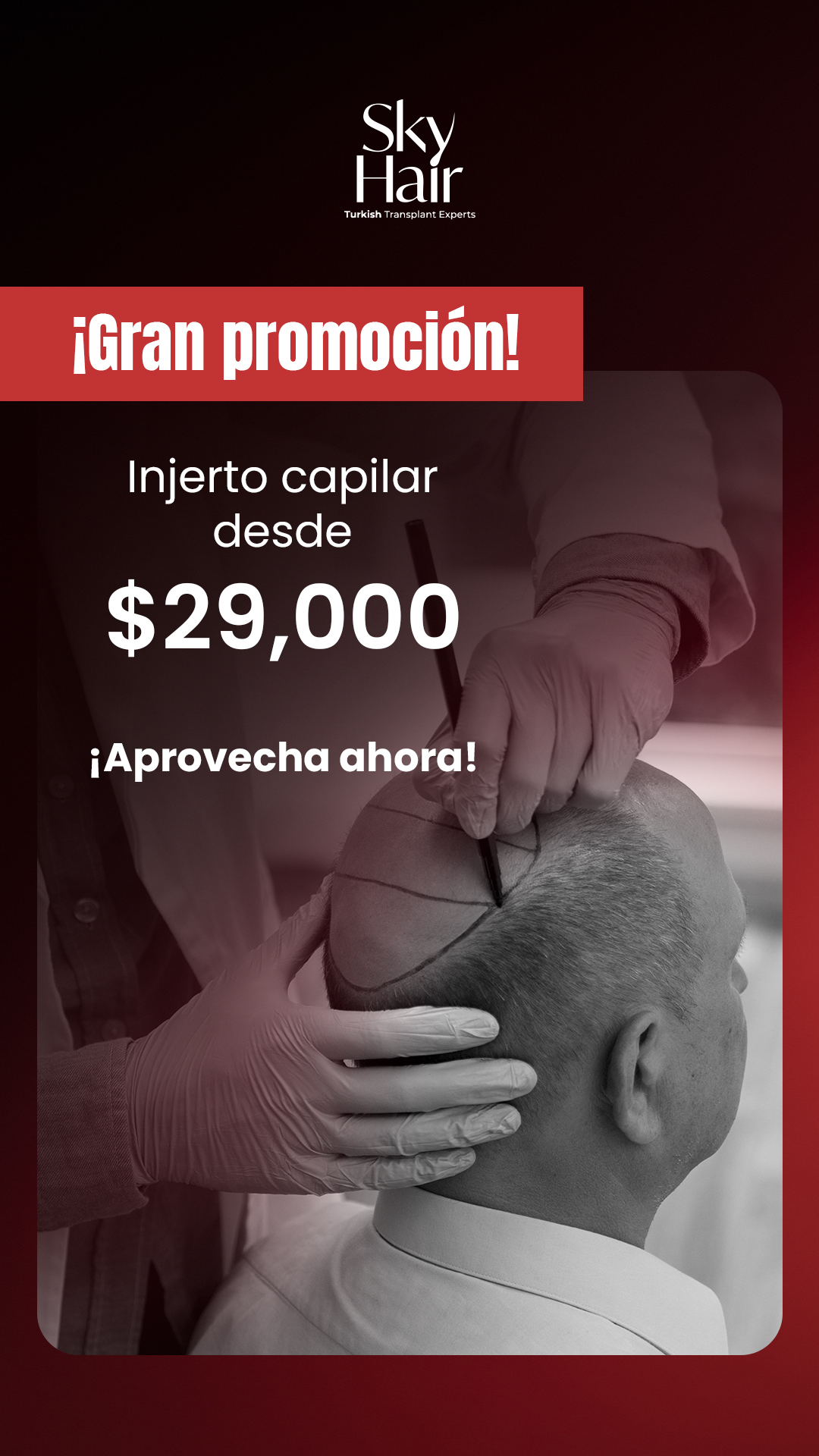 Sky Hair Transplants Facebook ad from Jan 20, 2026
