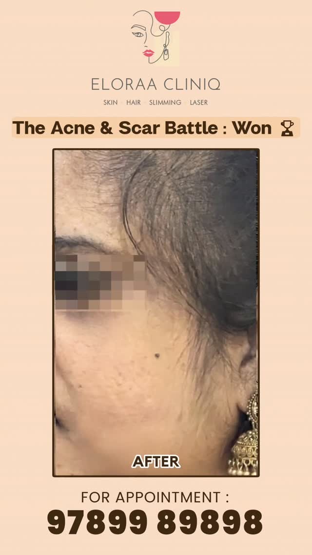 Eloraa Cliniq Facebook ad: For 8 long years, she battled stubborn acne…