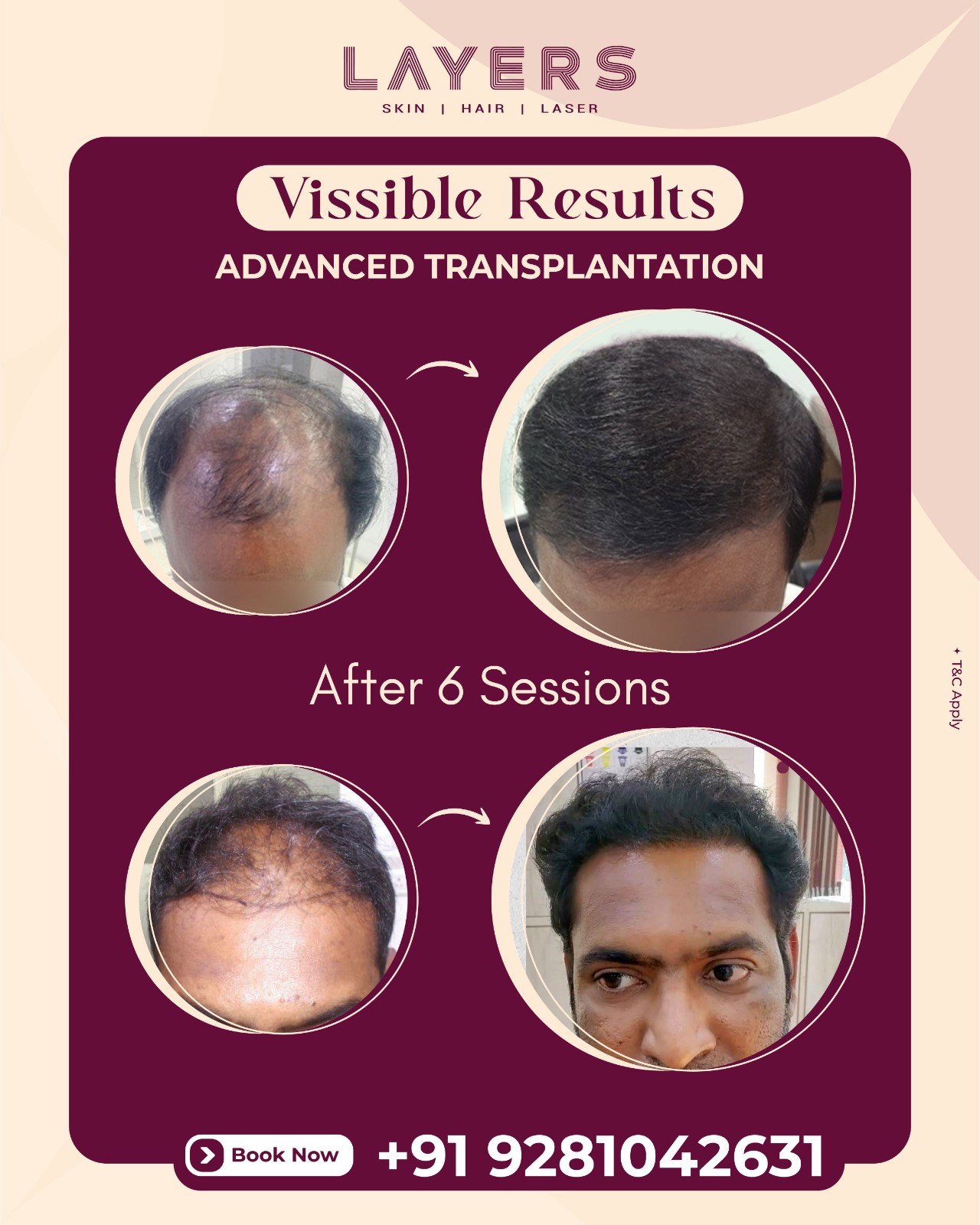 Layers Clinics Facebook ad