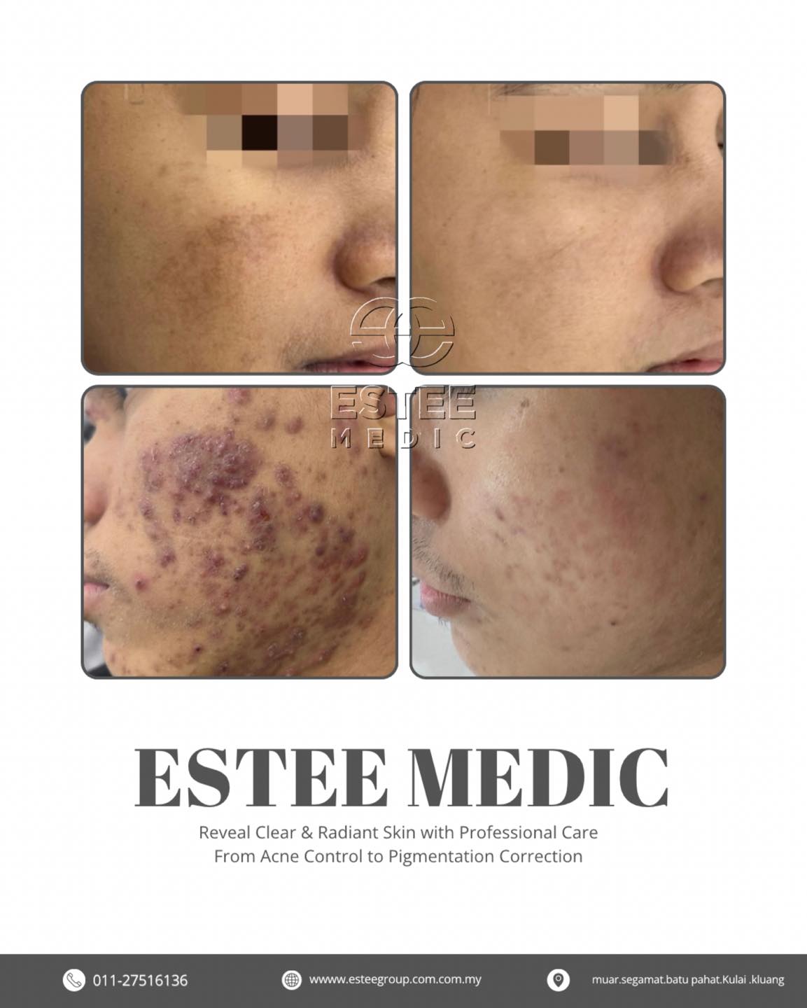 Estee Medic Muar Facebook ad: Are you struggling with acne and pigmentation issues?