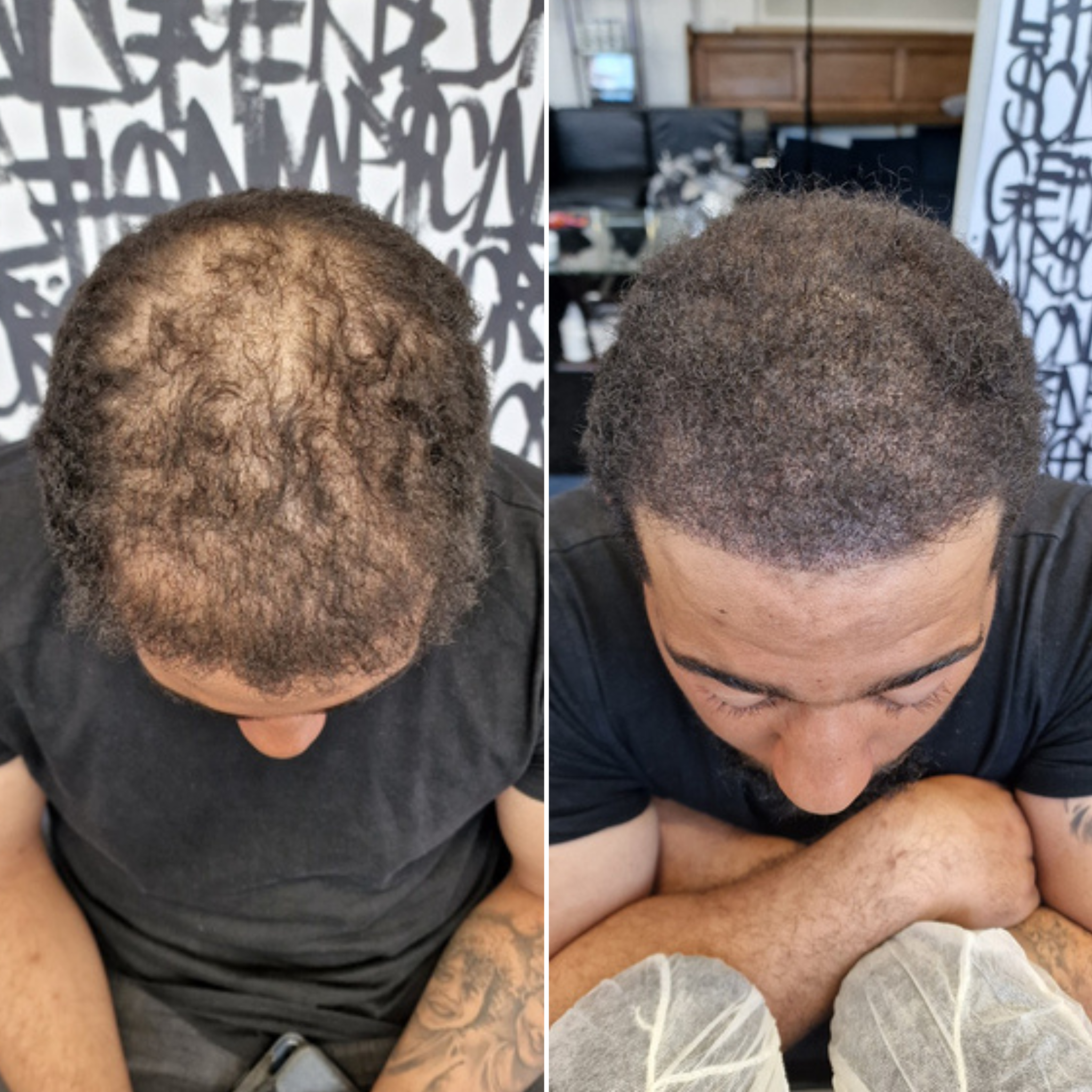 Scalp Micro UK Facebook ad: I got this done and it fixed my…