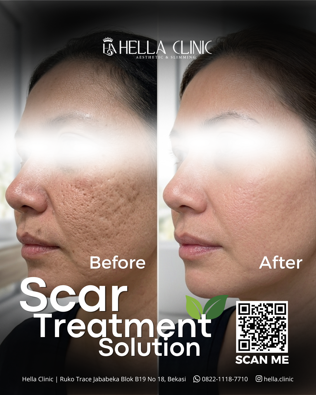 Hella Clinic Aesthetic & Slimming Facebook ad: Scar Treatment untuk Bekas Jerawat