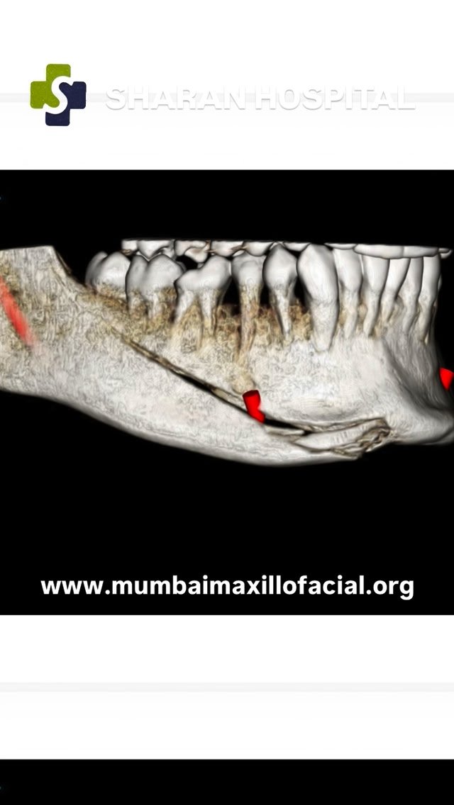 Sharan Hospital Facebook ad: Road Traffic Accident | Maxillofacial Trauma Management