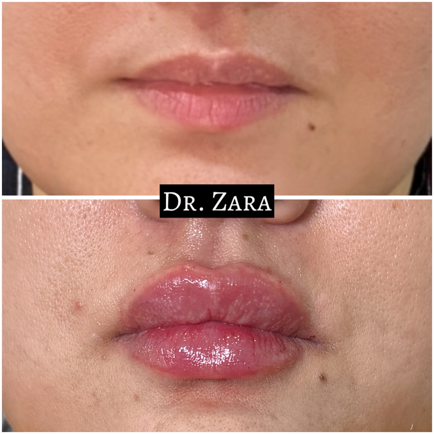 Dr Zara Says Facebook ad: Not your regular lip filler