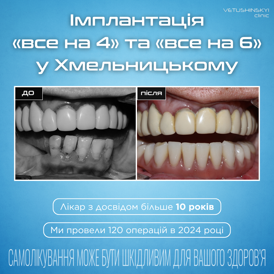 Vetushinskyi Clinic Стоматологія Ветушинського Facebook ad: VETUSHINSKYI clinic