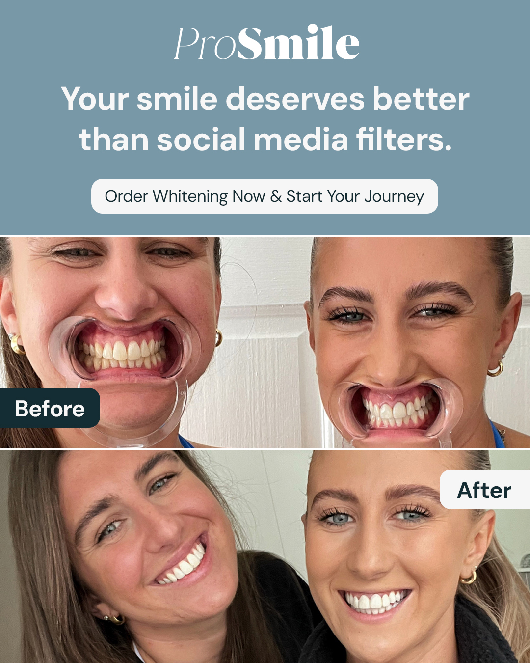 Pro Smile Facebook ad: Pro Smile | Teeth Whitening and Aligners