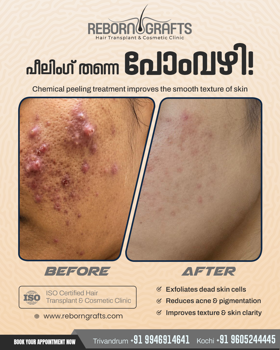 Reborn Grafts Facebook ad: Acne & Pigmentation Treatment