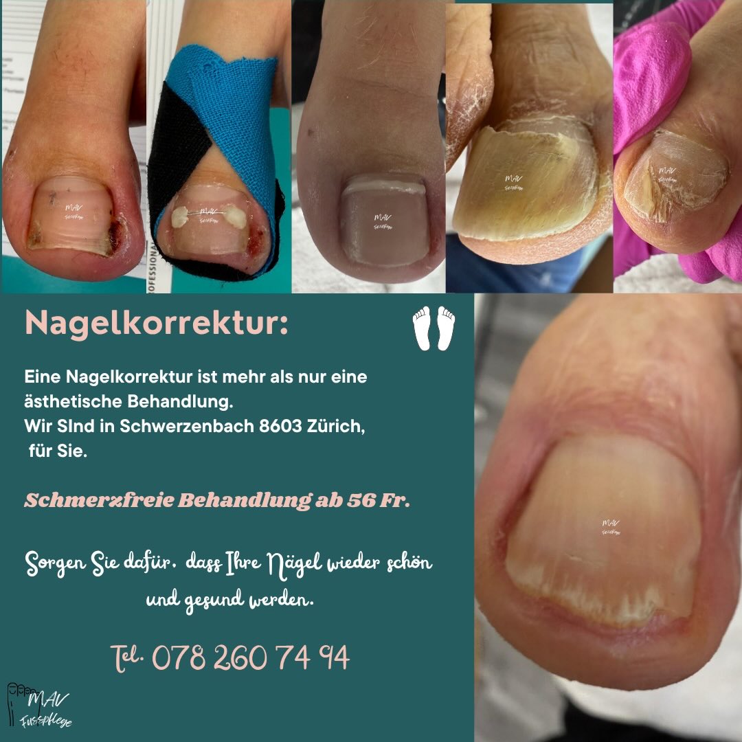 mavfusspflegerin Facebook ad: Nagelkorrektur mit Onyfix mehr als nur Ästhetik
