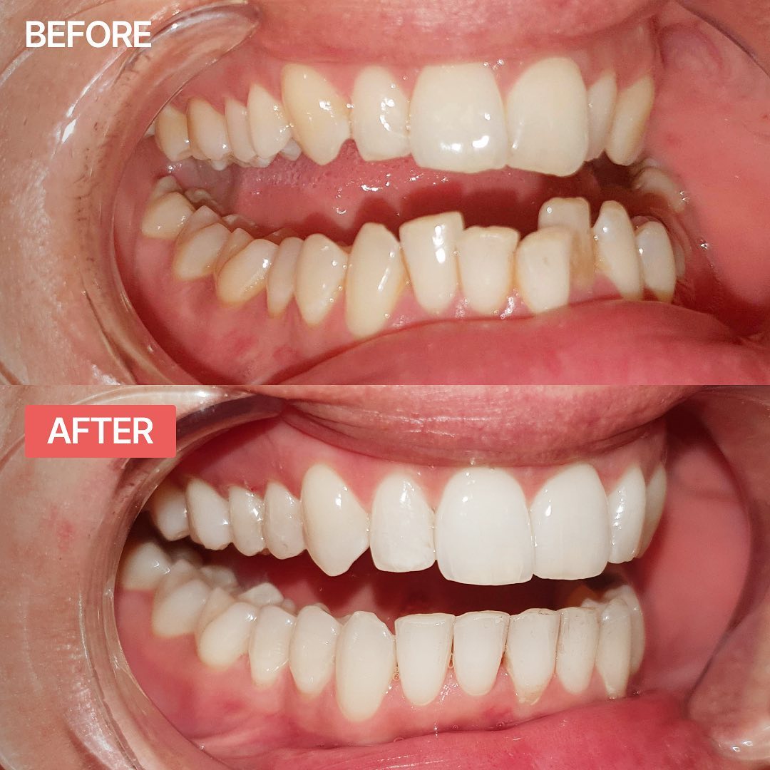 Impress USA Facebook ad: Impress orthodontics: braces or aligners? | Impress