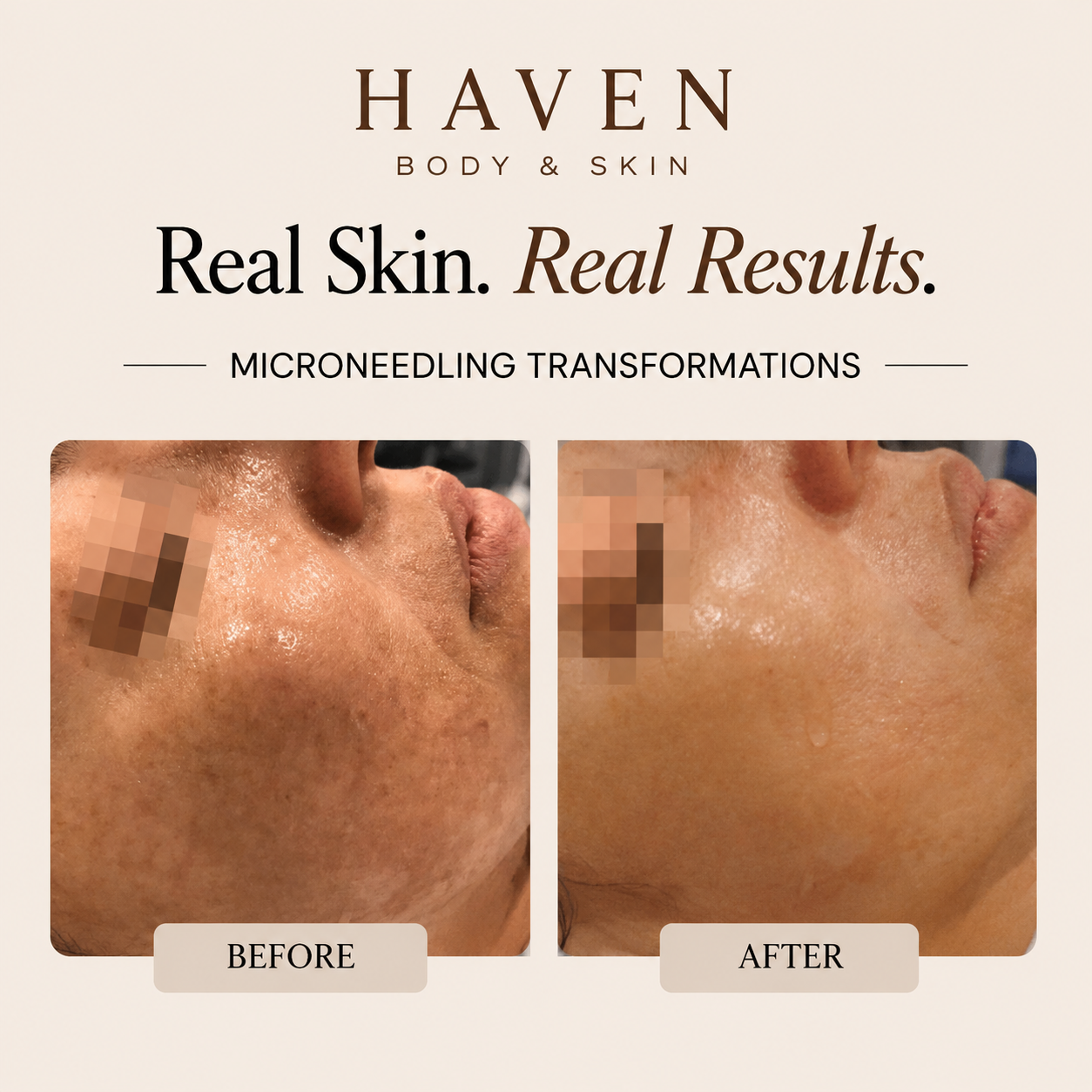 Haven Body & Skin Facebook ad: SAVE 30% OFF MICRONEEDLING