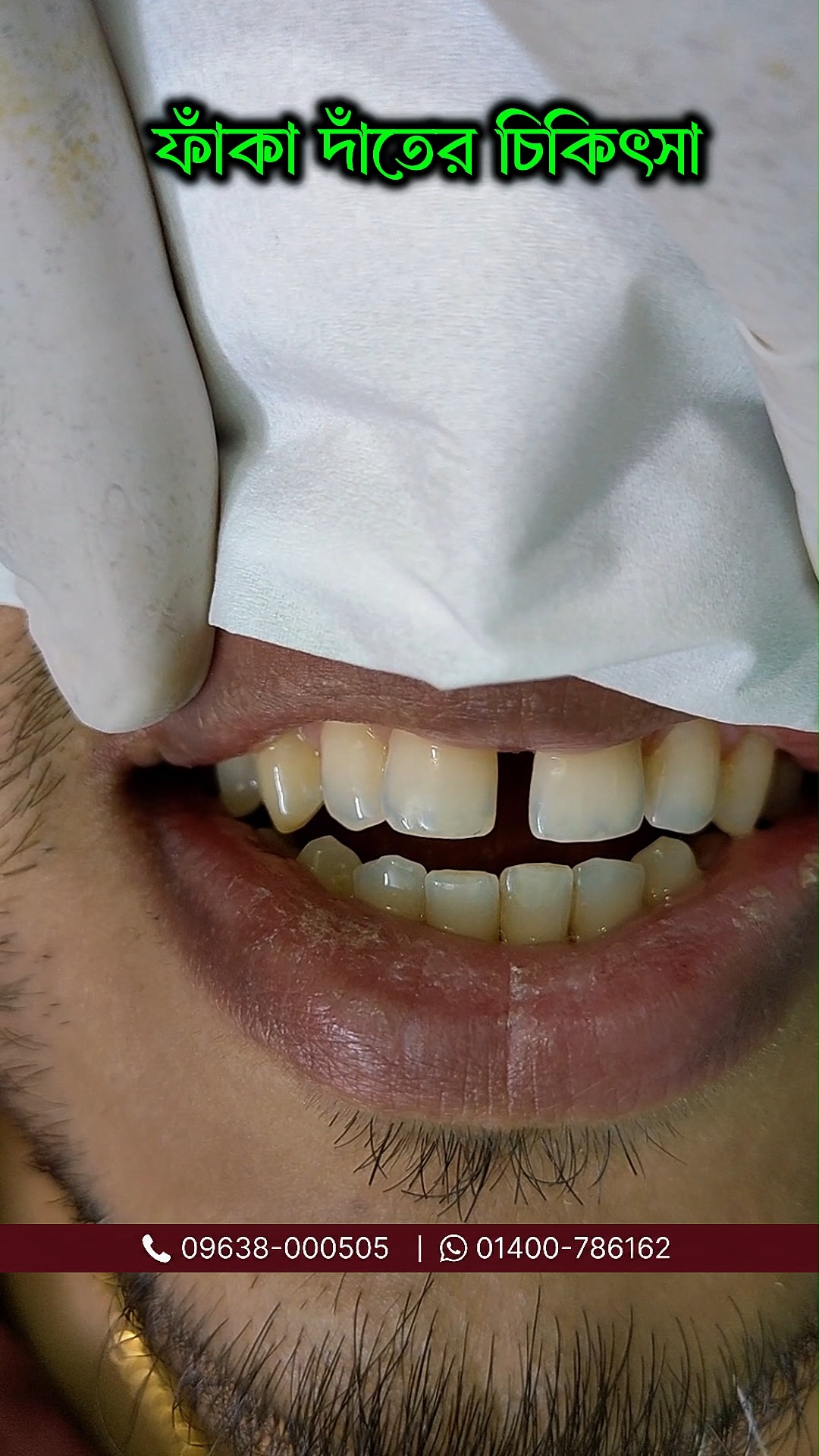 Tech Dental Facebook ad: মাত্র ৪০ মিনিটে ফাঁকা দাঁতের সমাধান।