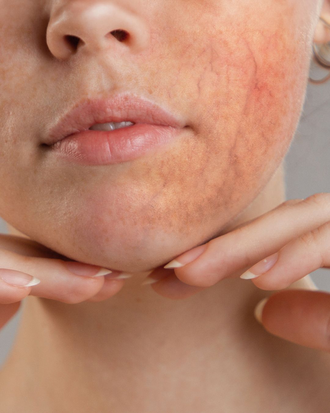 Skinmed AG Facebook ad: Rote Äderchen im Gesicht?